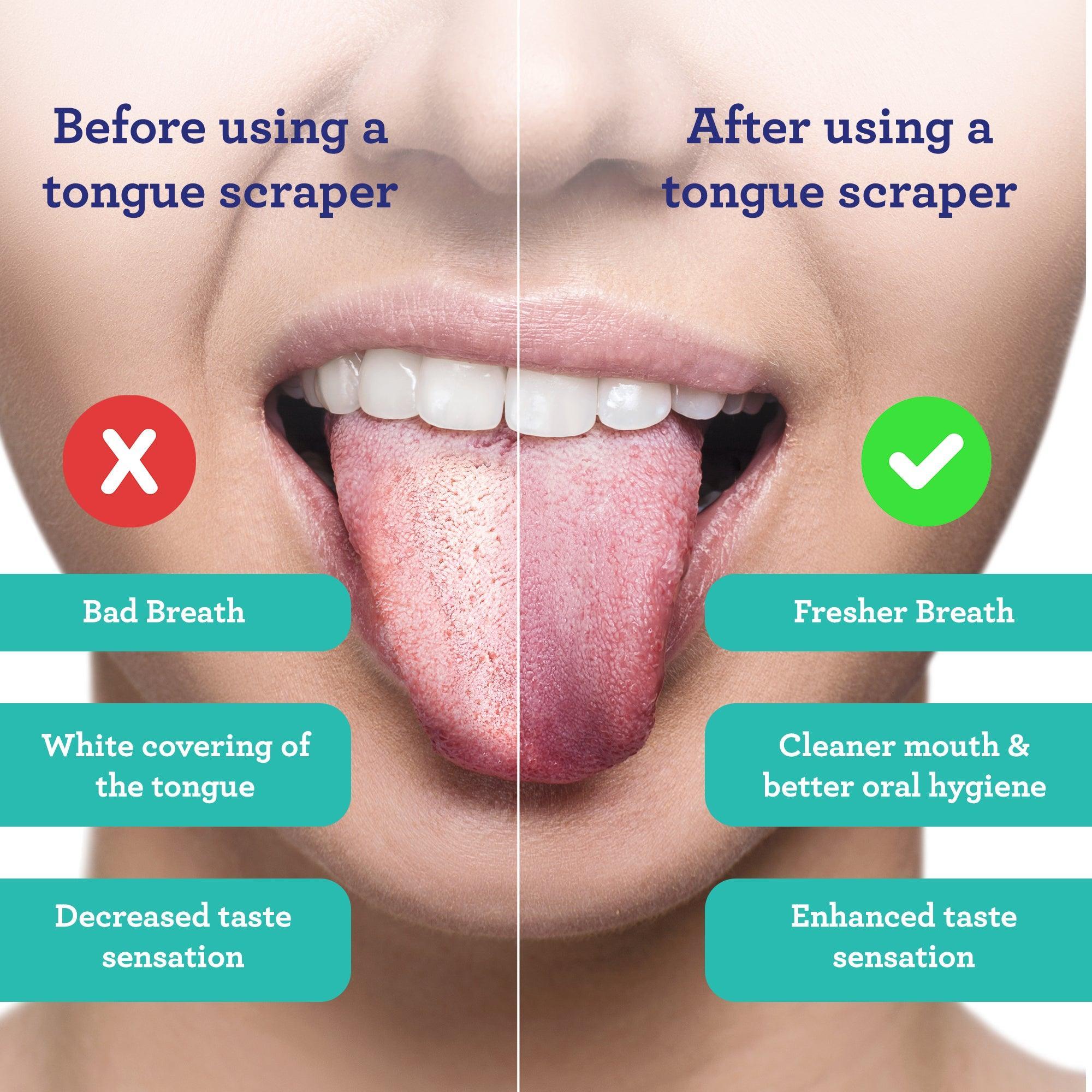 U Shaped Stainless Steel Tongue Scraper ¨C 2 Pack